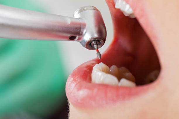 Best Emergency Tooth Extraction in Galt, CA